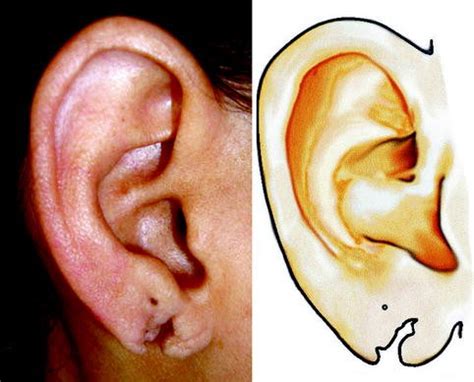 Cartilaginous Replacement Regeneration Or Reconstruction For Auricular