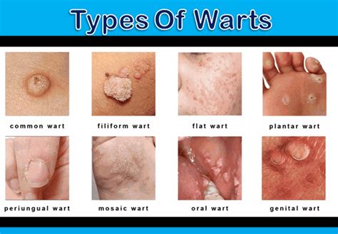 How To Identify A Wart Public Health