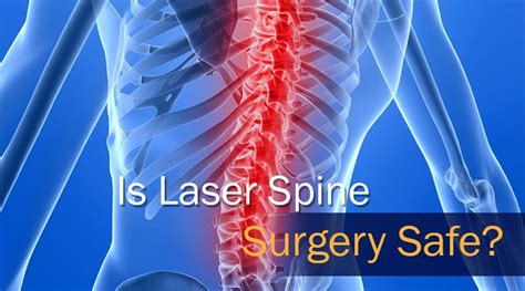 Is Laser Spine Surgery Safe