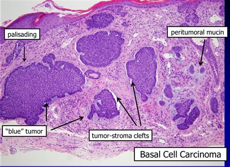 Basal Cell Carcinoma Histology Palisading