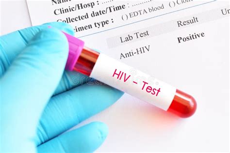 HIV Positive Test Result Stock Image Image Of Exam 124347721