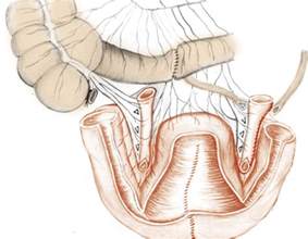 Continent Catheterizable Pouches For Urinary Diversion European