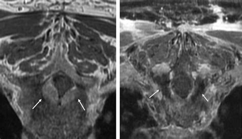 Termoterapia intersticial inducida por láser para metástasis