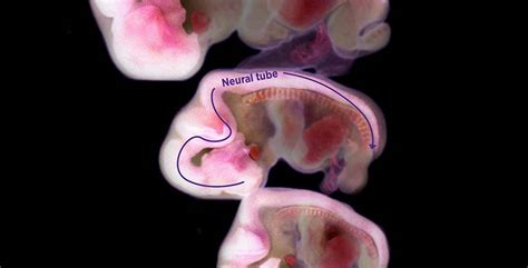 Neural tube and folate