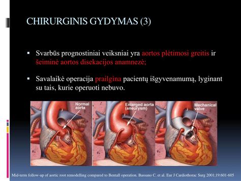 Ppt Marfano Sindromas Diagnostika Ir Gydymo Taktika Powerpoint