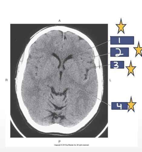 Sectional Anatomy Chapter Brain Flashcards Quizlet