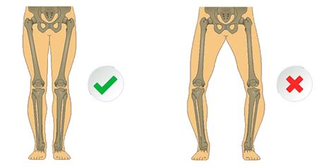 Genu Varum symptômes causes et traitements