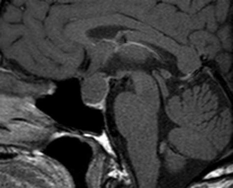 Figure 18 Sagittal Enhanced T1 Weighted Image Endotext NCBI