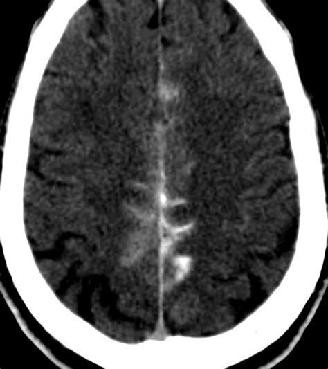 Imaging Evaluation Of SAH And Aneurysm The Neurosurgical Atlas