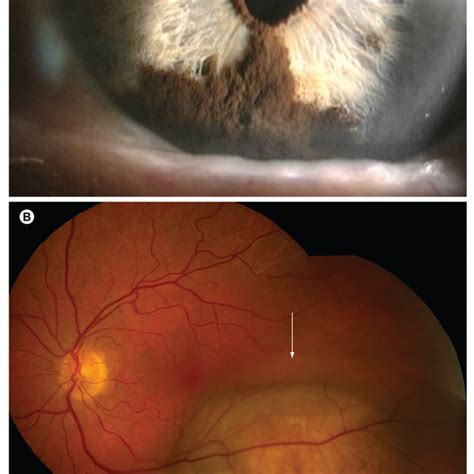 Molecular Classification Of Uveal Melanomas Based On Transcriptomic And