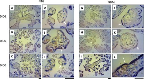 GDM Effect On DIO2 And DIO 3 Expression In Placental Tissue DIO2 And