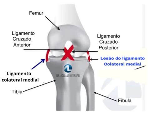 Deslocando O Joelho - O seu joelho saiu do lugar? Saiba o que fazer após o deslocamento da ...