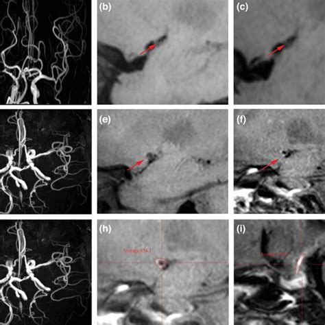 Case 1, A 48‐year‐old female with severe stenosis of right middle ...