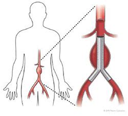 My Surgery Endovascular Aneurysm Repair EVAR