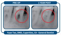 Lanap Laser Treatment Hope For Hopeless Teeth Millennium Dental