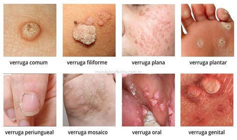 Verrugas Conhe A Os Tipos Causas E Tratamentos E Saiba O Que Fazer