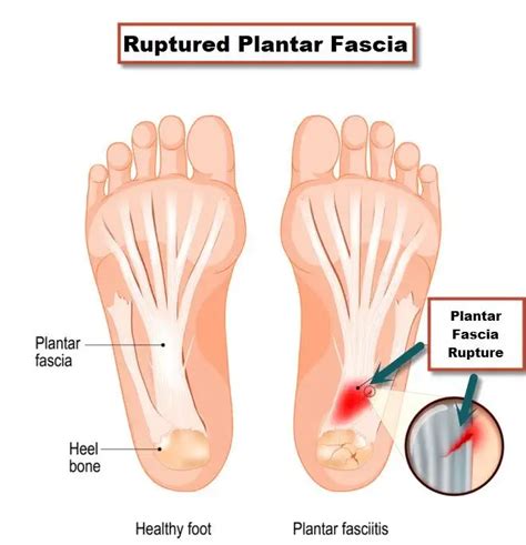 25+ Plantar Fascia Tear Treatment - ChowRhubie