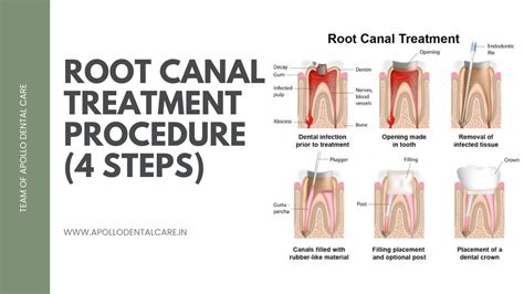 Root Canal Treatment Procedures (4 steps) - Apollo Dental Care