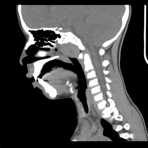 Location Of Adenoidsthe Structure Of The Nasopharynx