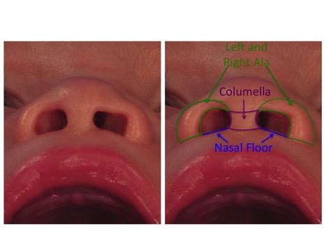 Cleft Nasal Anatomy — Dallas Pediatric Plastic Surgeon Craniofacial