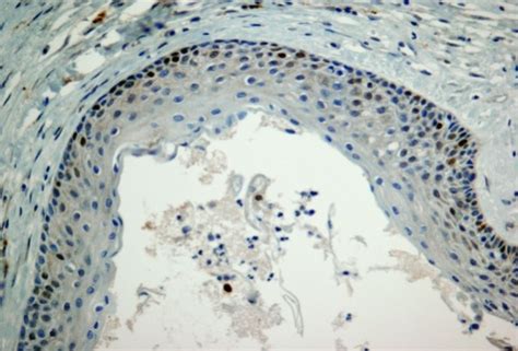 Keratocystic Odontogenic Tumors Clinical And Molecular Features