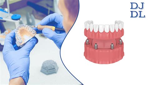 How Are Implant Supported Dentures Placed Dave Johnson