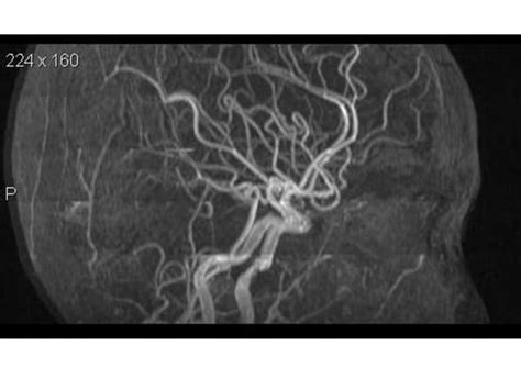 Magnetic Resonance Angiography Ppt