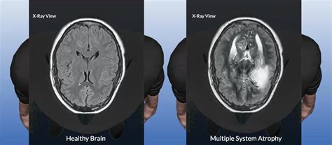 Multiple System Atrophy Treatment With Stem Cells Swiss Medica