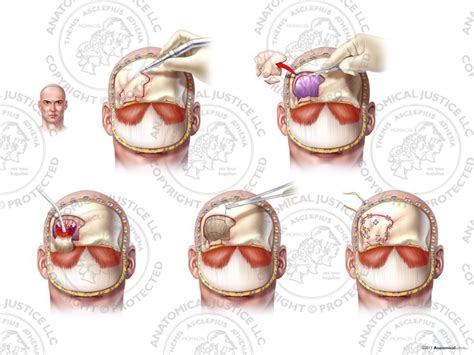 Male Right Frontal Craniotomy And Subdural Hematoma Removal No Text