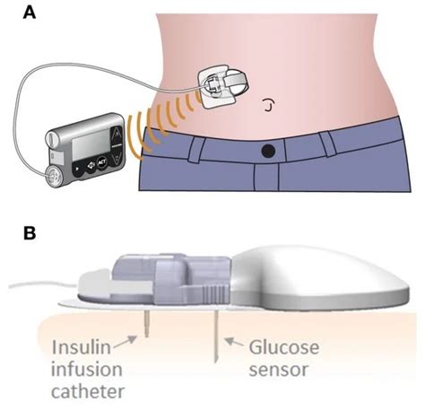 Medtronic Cgm Sensor Insertion - Sensor Education Blog