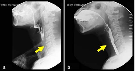 Lateral Videofluoroscopic View Of The Pharynx Of A 56 Year Old Man With