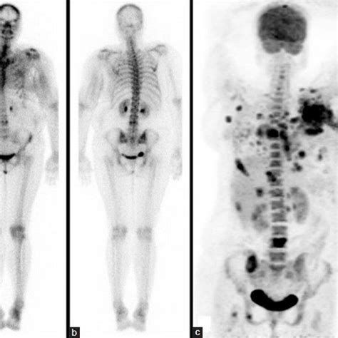 Whole Body Bone Scan In Anterior A And Posterior B Views Of A