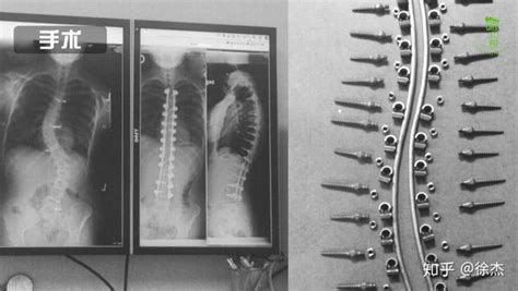科学的脊柱侧弯治疗方法简介 知乎