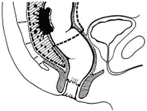 A Compass To Navigate Transanal Total Mesorectal Excision Journal Of