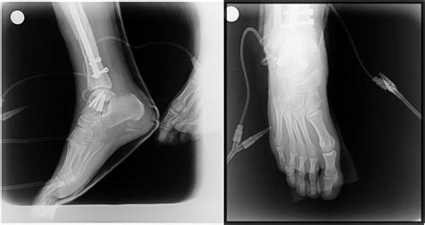 Immediate Post Operative X Ray Of The Right Foot Anterior Posterior