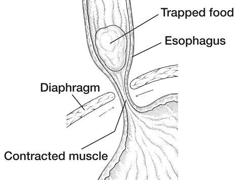 Esophagus Showing Achalasia Media Asset Niddk