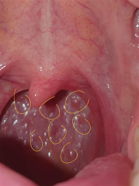 Normal Bumps On Back Of Throat