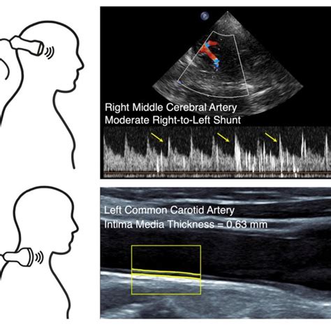 Non Invasive Ultrasound A Transcranial Doppler Tcd Bubble Test