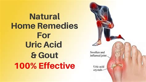 Uric Acid Treatment Naturally At Home | Causes, Symptoms of Uric Acid ...