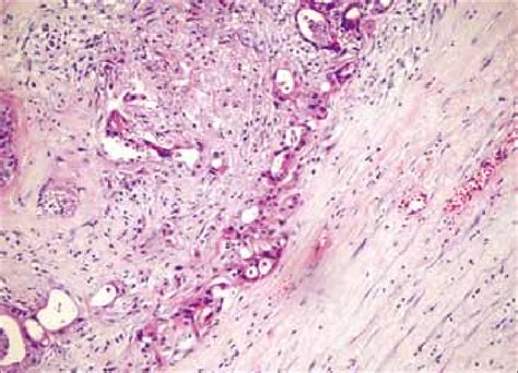 Microscopic Appearance Of Metastatic Primary Lung Adenocarcinoma In The Download Scientific