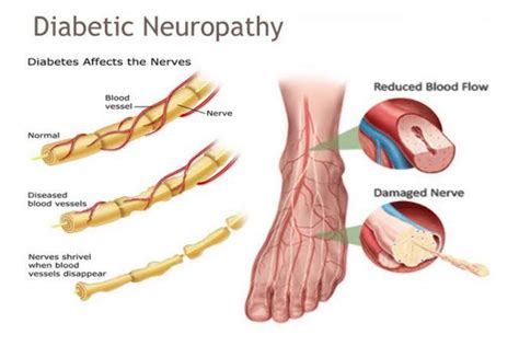 Diabetic Neuropathy Amputation Free India