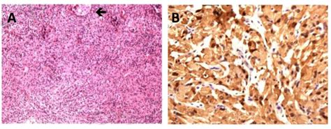 Histological Features Of Rosai Dorfman Disease Involving Sellar Region