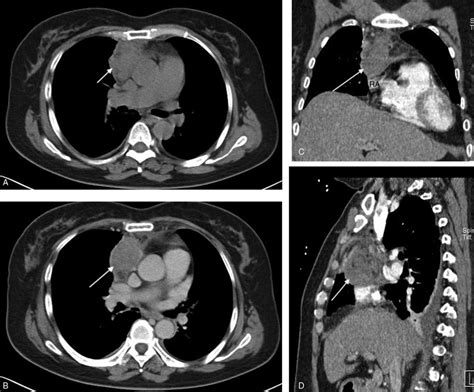 The CT scan of the mass (arrow) in the anterior mediastinum. (A) It is... | Download Scientific ...