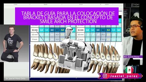 Tabla de guía para la colocación de brackets basada en el concepto de