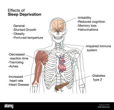 The Many Effects Of Sleep Deprivation Some Of These Include