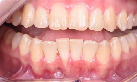 Soft Tissue Graft On Lower Anterior Teeth Before And After Photos