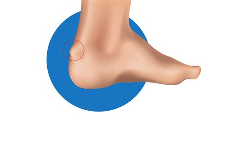 Haglund Deformity Foot Ankle Centers Of Frisco And Plano