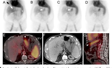 Nuclear Medicine Tests For Acute Gastrointestinal Conditions