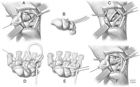 Ulnar-sided wrist pain: diagnosis and treatment. | Semantic Scholar