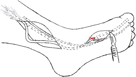 Double-incision technique (1). FHL tendon, (2). FDL tendon, (3 ...